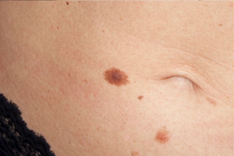 Šta je tumor kože?