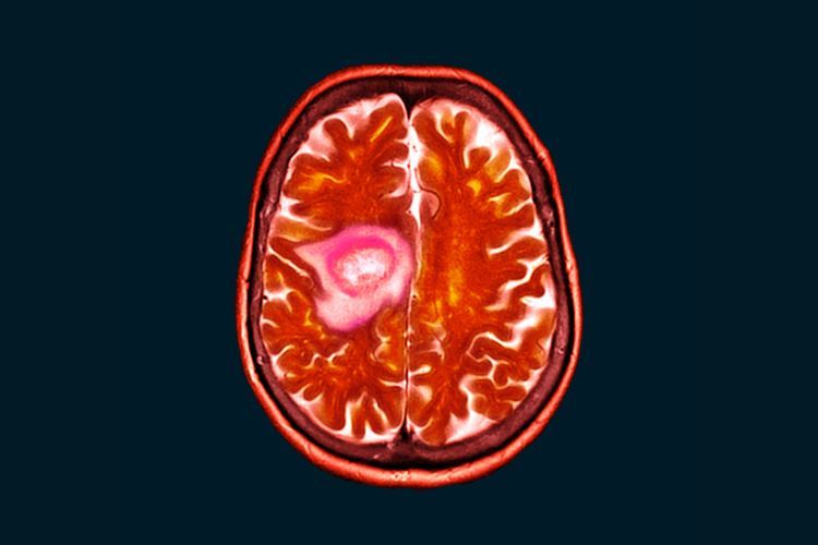 Šta je glioblastom (GBM)?