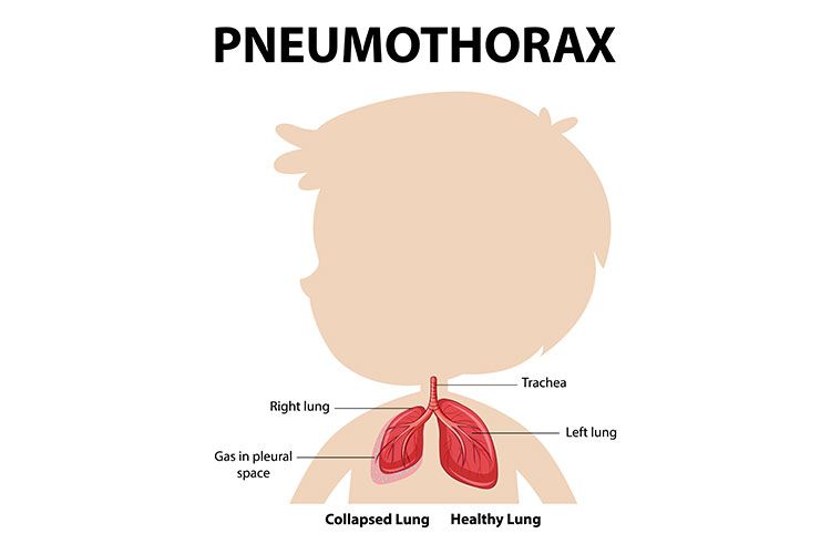 Šta je pneumotoraks?