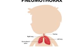 Šta je pneumotoraks i kako ga prepoznati?