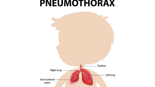 Pneumotoraks: prepoznavanje i lečenje