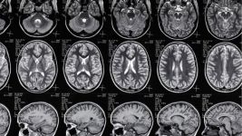 Encefalitis: Uzroci, simptomi i lečenje