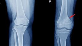 Funkcija i značaj čašice (patela) u ljudskom telu