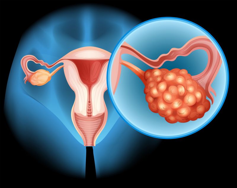 Tumor jajnika