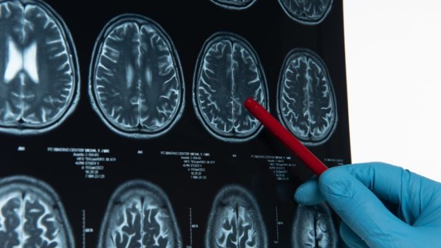 Lečenje i prevencija anomalija krvnih sudova u mozgu Lečenje i prevencija anomalija krvnih sudova u mozgu