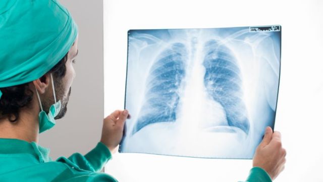 Fibrotoraks: Uzroci, simptomi i tretmani Fibrotoraks: Uzroci, simptomi i tretmani