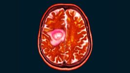 Glioblastom: Uzroci, simptomi i mogućnosti lečenja