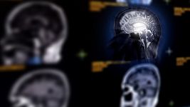 Razumeti ishemiju mozga: uzroci, simptomi i lečenje