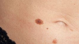 Simptomi, dijagnoza i lečenje tumora kože