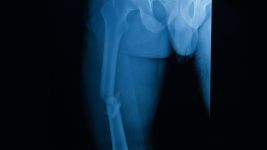 Razumevanje preloma femura: Uzroci, simptomi i tretmani