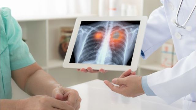 Mezoteliom: uzroci, simptomi i lečenje Mezoteliom: uzroci, simptomi i lečenje