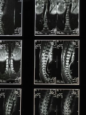 MSCT snimanje kičme